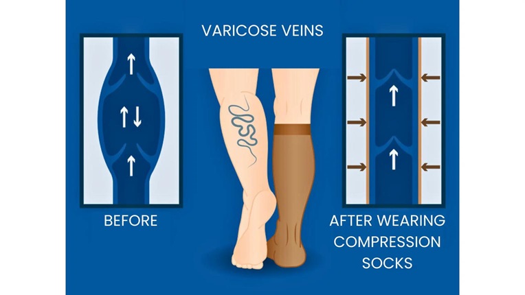 Compression stockings can help relieve symptoms associated with varicose veins.
